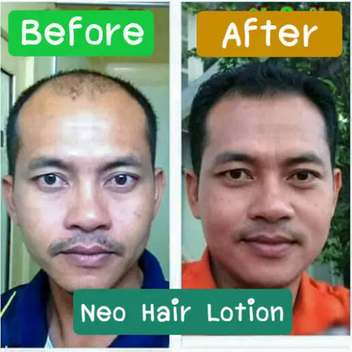 5X Hair Care Neo Hair Lotion