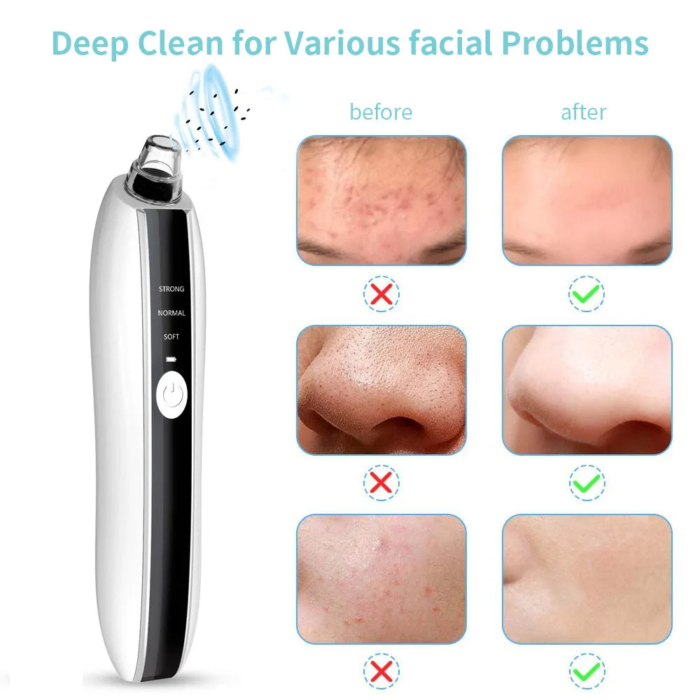 Acne Pimple Extractor Vacuum